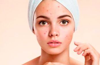 Acne - Clínica Aguilar Rosell