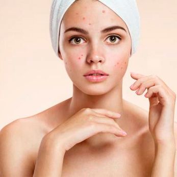 Acne - Clínica Aguilar Rosell