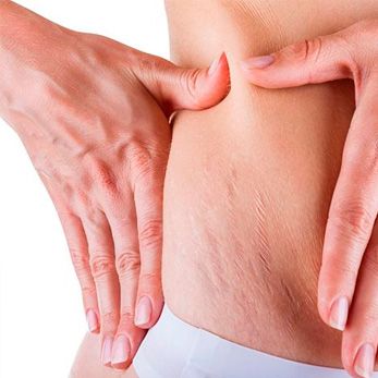 tratamientos-de-estrias Tratamientos estrías - Clínica Aguilar Rosell