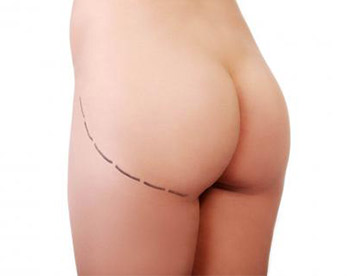 Nalgas - Clínica Aguilar Rosell Torremolinos