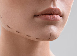 Implantes faciales - Clínica Aguilar Rosell Torremolinos