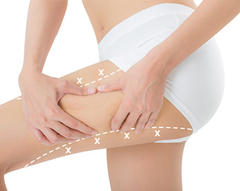 Lifting muslos - Clínica Aguilar Rosell Torremolinos
