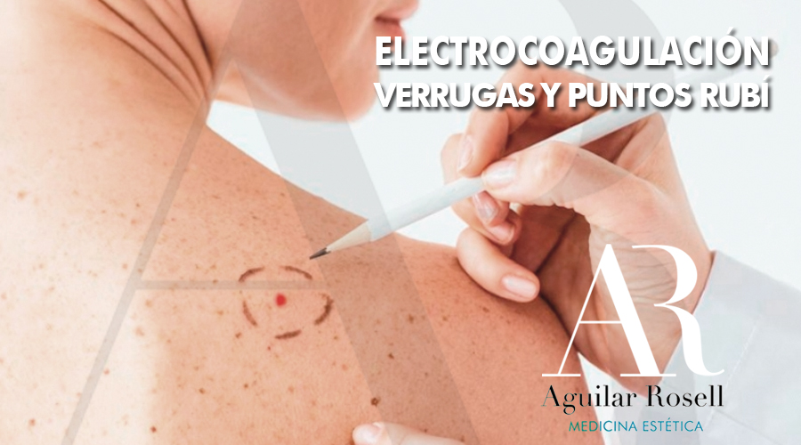 electrocoagulacion