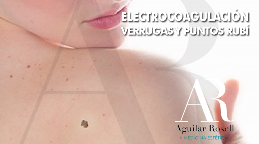 quitar verrugas en torremolinos