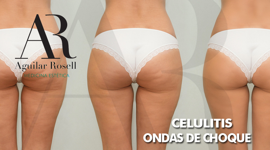 celulitis ondas de choque